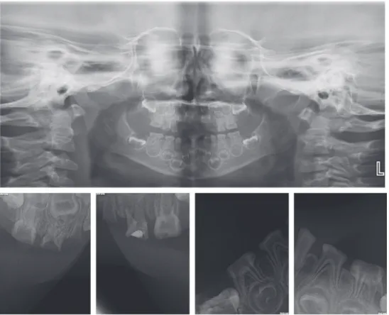 Fig. 1. Clinical photographs before and after the treatment indicating improvement of esthetic and masticatory function.