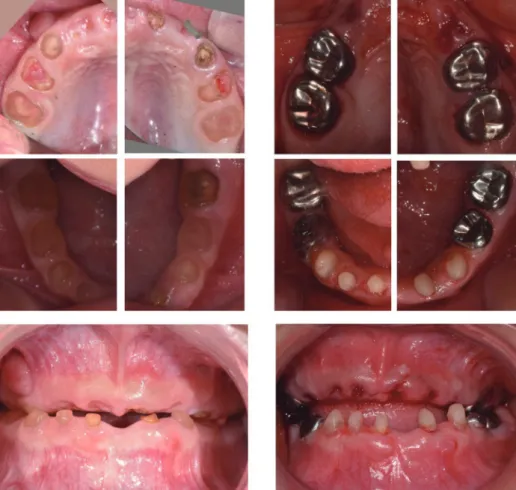 Fig. 2. Panoramic and standard radiographic views at initial visit. The teeth show enlarged pulp chamber with thin dentinal wall