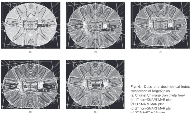 Fig.  4.  Dose  and  dosimetrical  index  comparison of Target2 plan (a) Original CT image plan (metal free) (b) 1T non-SMART MAR plan (c) 1T SMART MAR plan (d) 2T non-SMART MAR plan (e) 2T SMART MAR plan