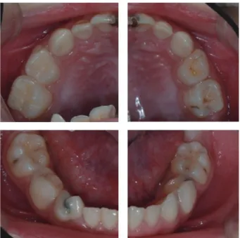 Fig. 5. Panoramic radiograph: 4 years 2 months after treatment.