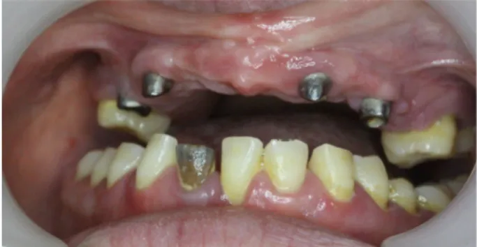 Fig. 5. Remade 10-unit zirconia bridge using CAD/CAM system. 