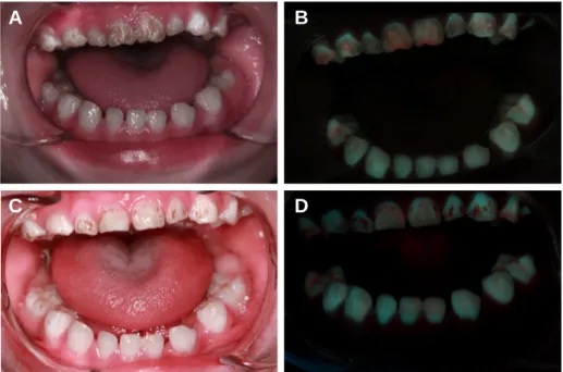 Fig. 3. Intra-oral view and QLF-D view taken at the visit for regular check up.