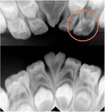 Fig. 3. Intraoral view of pre-operation. Fig. 4. Intraoral view of post-operation.