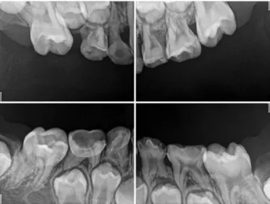 Fig. 2. Intraoral  photos  before  treatment.  Multiple  dental caries were observed. The right maxillary first molar was shifted to the mesial side and the eruption space of right maxillary  second  premolar  was  obstructed  due  to  the early loss of th