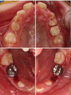 Fig. 3. Intraoral x-rays after treatment.