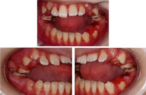 Fig. 3. Postoperative intraoral photos at second visit. Scaling and extraction of primary teeth except #55 and #65 with no mobility was completed.