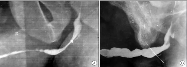 Fig. 6. (A) Preoperative retrograde urethrogram (RGU). (B) Postoperative RGU after 2 years.