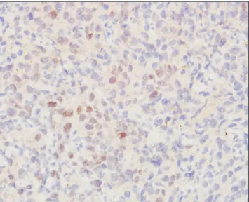 Fig. 2. Low Ki67 staining pattern. Strong positive staining pattern for  estrogen receptor beta (immunohistochemical staining, ×10).