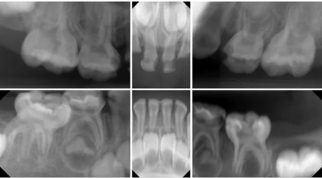 Fig. 1. Intraoral radiograph before treatment.