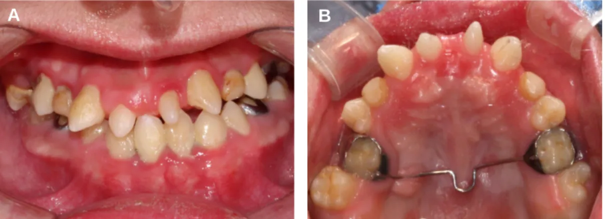 Fig. 1. Pre-operative intraoral view demonstrating conical tooth shape.