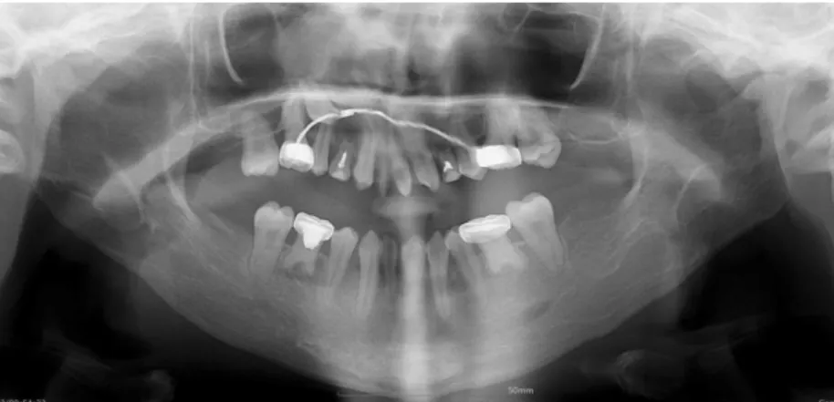 Fig. 2. Panoramic view. Congenital missing teeth (#12, 15, 17, 22, 23, 25, 27, 31, 35, 37, 41, 45, 47), ectopic impacted teeth (#13), retained primary teeth (#53, 55, 63, 65, 75, 85).