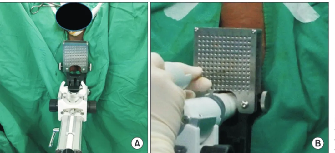 Fig. 1. (A) The set-up of the probe which  was attached to a brachytherapy grid  with 5-mm spacing and cradle
