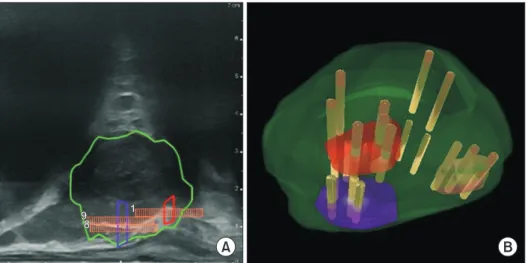 Fig. 2. (A) Sagittal Real-time US target- target-ing of the ROI. ROI 1 (red), ROI 2 (purple),  and prostate contour (green)