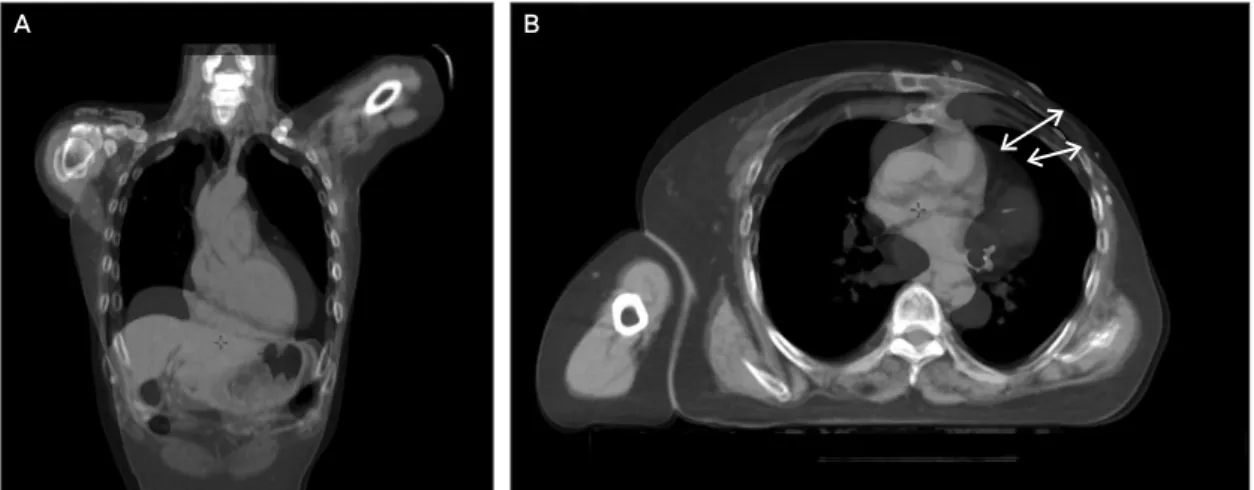 Fig. 2. A : Coronal CT image, B : Transverse CT image 