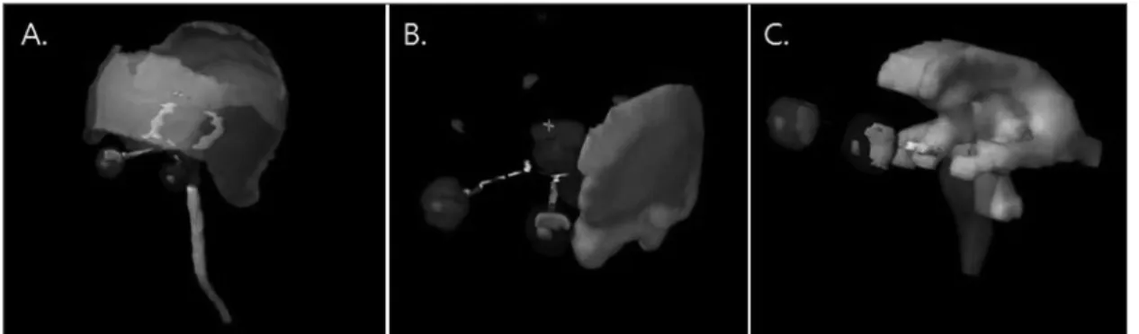 Fig. 1. 3D reconstruction of OAR and PTV (A) Whole Scalp, (B) Partial Scalp, (C) Whole Ventricle.