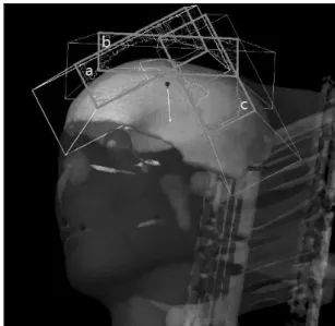 Fig. 3. Three fields at Gantry angle 60°, Couch angle 335°us- 335°us-ing Fixed Jaw