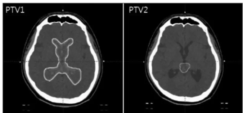 Fig. 4. PTV1 and PTV2 of Whole Ventricle