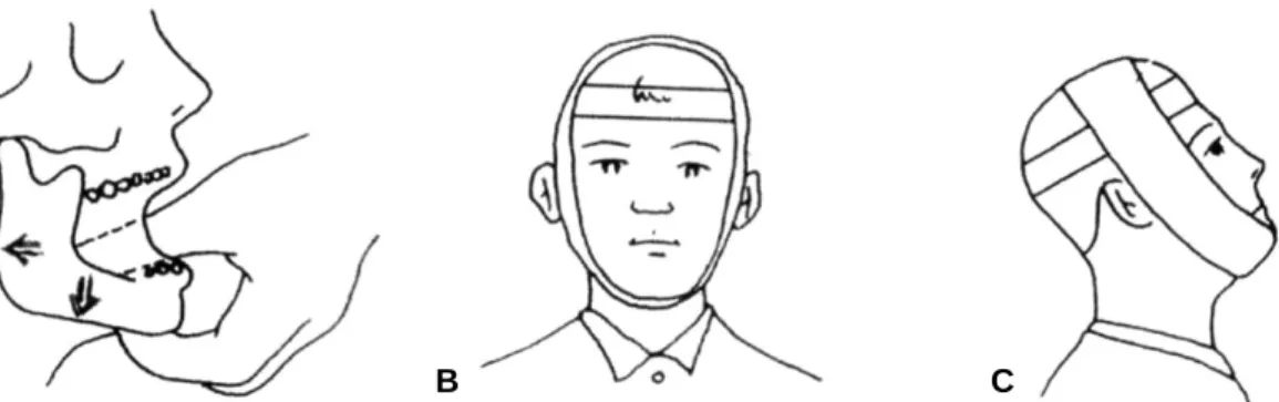 Fig. 2. Manual reduction method (A) and fixation by Barton's bandage (B. C). (Modified from Kim SN, Yum KW, Lee MS, Lee SW, Lee SJ : Emergency care in the dental office, 3rd ed