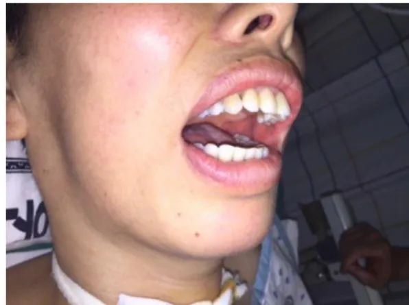 Fig. 3. Reduction  of  temporomandibular  joint  dislocation  and fixation with multiple loops wiring and intermaxillary elastics.