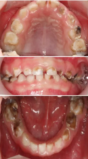 Fig. 5. Extracted  teeth  (Mandibular  left  and  right  primary  first