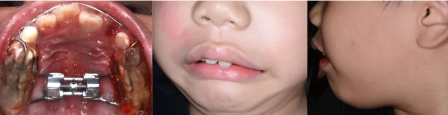 Fig. 3. Lingual movement of ectopic maxillary central incisor was observed in 3 month later.