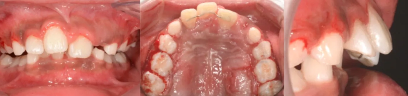 Fig. 4. Post-treatment photographs. Considerable lingual movement of right maxillary central incisor was observed.