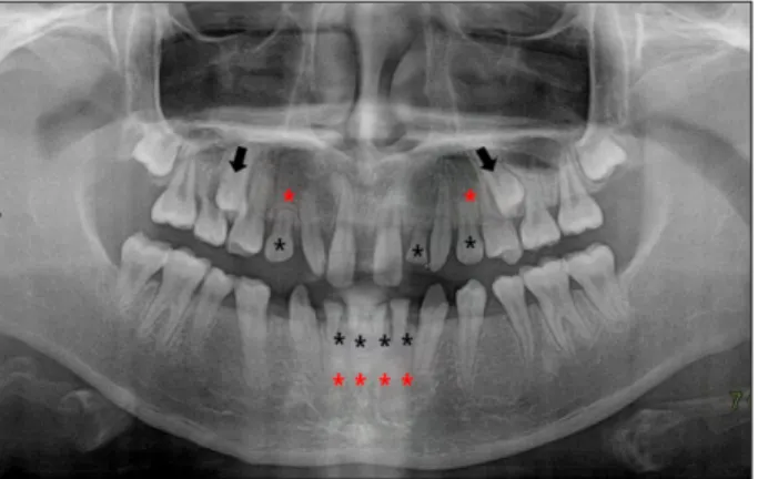 Fig. 1. Pre-operative intraoral photo. Fig. 2. Panoramic view. Congenital missing teeth (#13, 23, 31, 32, 41, 42), ectopic impacted teeth (#15, 25), retained primary teeth (#53, 62, 63, 71, 72, 81, 82) and spacing.