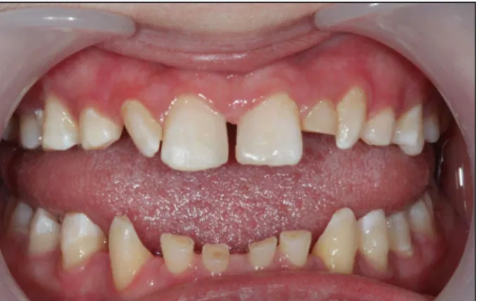 Fig. 3. Diagnostic wax - up with putty index. Fig. 4. Post-operative intraoral photo.