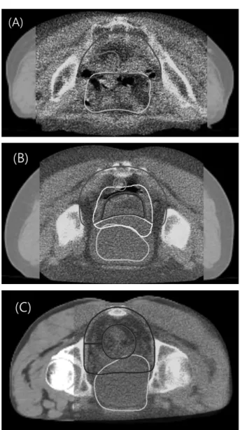 Fig. 3. (A) Empty bladder (B) Over bladder (C) Suitability bladder