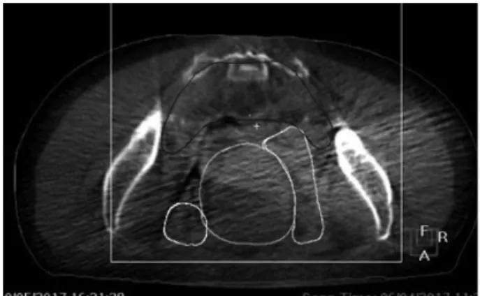 Fig. 8. The artifact of CBCT in pelvis