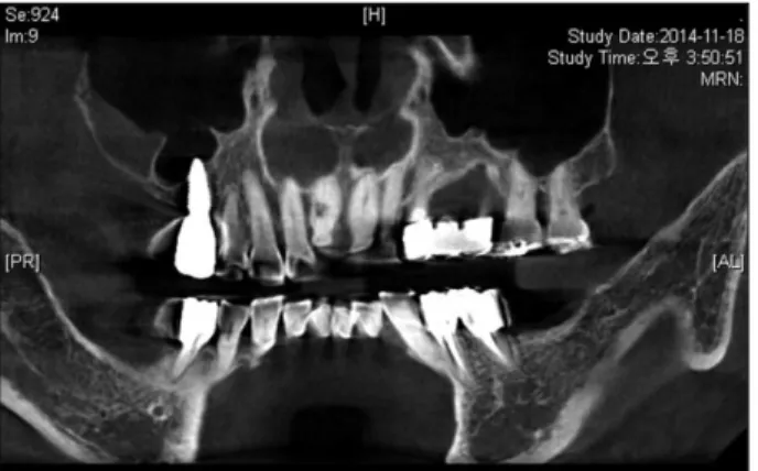 Fig. 4. Initial panoramic view. Fig. 5. Initial Cone Beam Computed Tomogram.