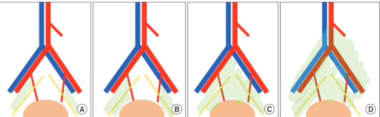 Fig. 1. Definitions of pelvic lymph node dissection templates. Limited pelvic lymph node dissection (PLND) (A), standard PLND (B), extended  PLND (C), and superextended PLND (D).