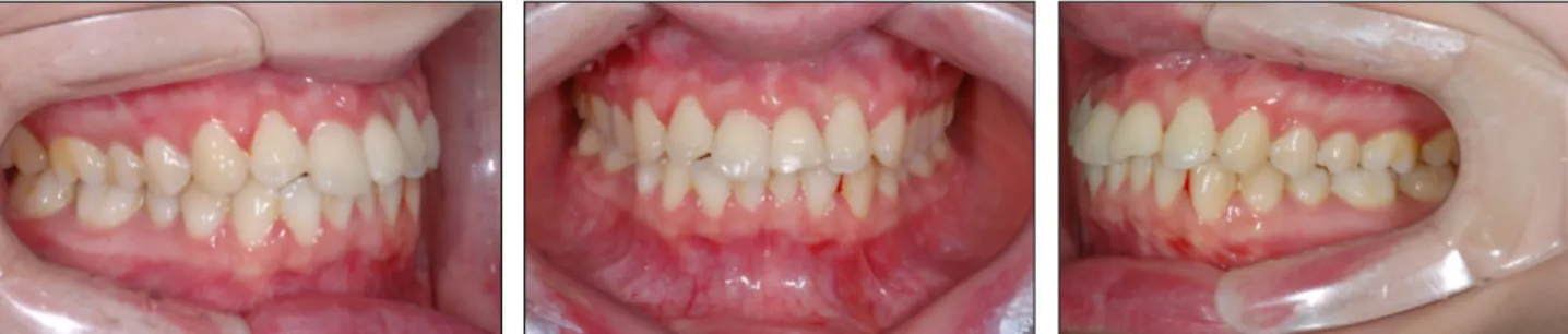 Fig. 4. Clinical photos after 2 weeks stabilization using vacuum-formed splint.