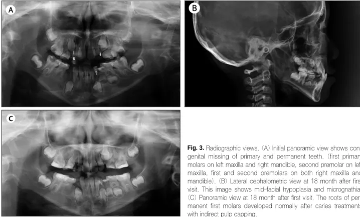 Fig. 3. Radiographic views. (A) Initial panoramic view shows con- con-genital  missing  of  primary  and  permanent  teeth