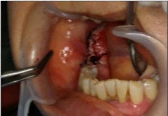 Fig. 4. Primary wet gauze biting view for bleeding control.