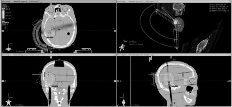 Fig 3. Novalis 6MV of Two Arc Brian Rando Phantom IMRT plan