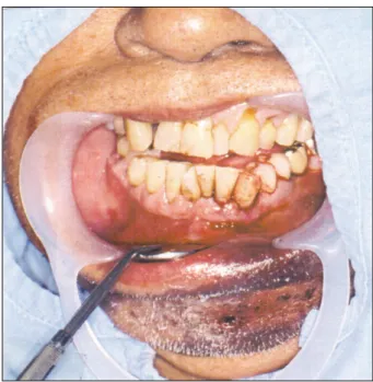 Fig. 1. Initial gingival bleeding view on mandibular teeth.
