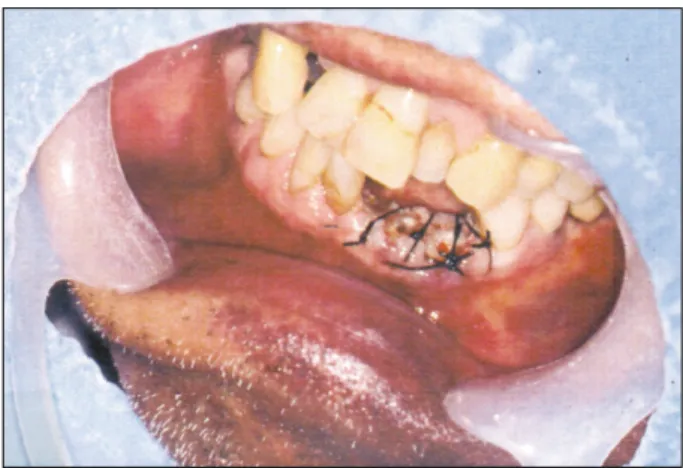 Fig. 3. Wet gauze biting &amp; dental floss silk application view for prevention of aspiration during sleeping.