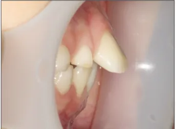 Fig. 1. Maxillary teeth at first visit. Difficulties in anterior lip seal and excessive spacing was shown.