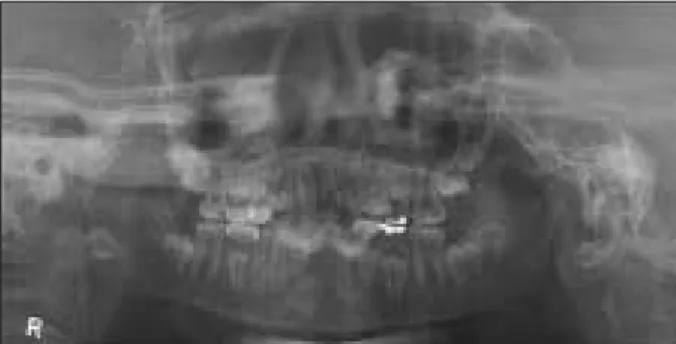 Fig. 1. Panoramic radiograph at the first visit. Fig. 2. Pre-operative intraoral radiograph at the first visit.