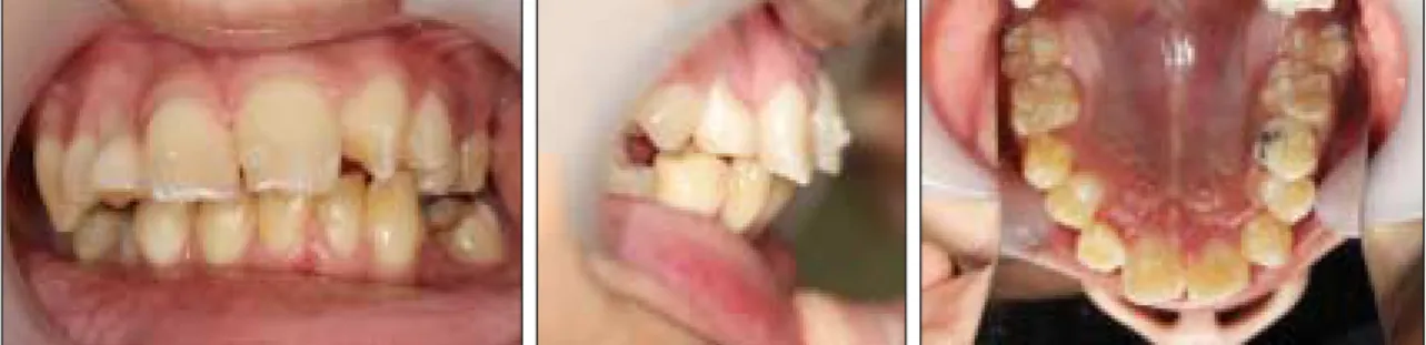 Fig. 6. Compariosn  of  upper  incisor  inclination  between  pre- pre-treatment and post-pre-treatment.