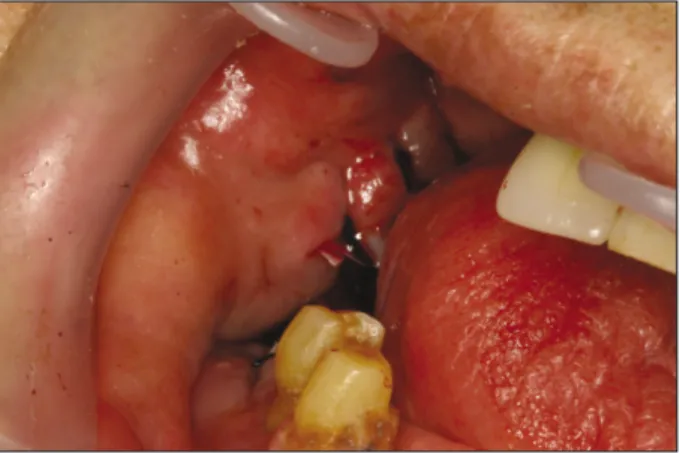 Fig. 3. Incision &amp; drainage view on the superficial temporal space abscess.