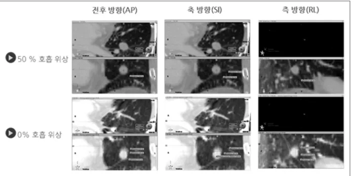 Fig 1. Measurement of tumor motion in 4DCT images