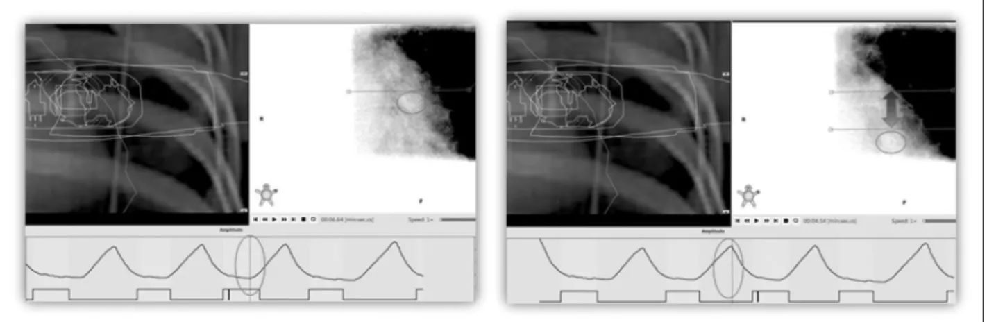 Fig 4. Set up the respiration Upper-Lower range on fluoroscopy images.