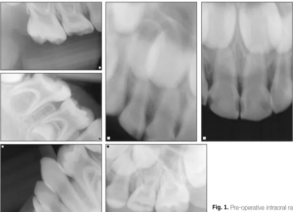 Fig. 1. Pre-operative intraoral radiograph.