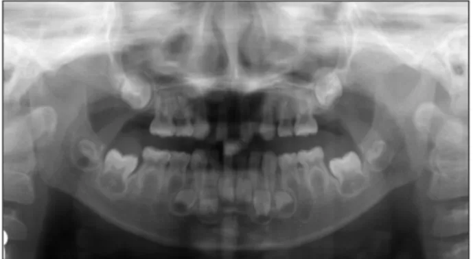 Fig. 1. Panoramic radiograph (2002. 3. 15).