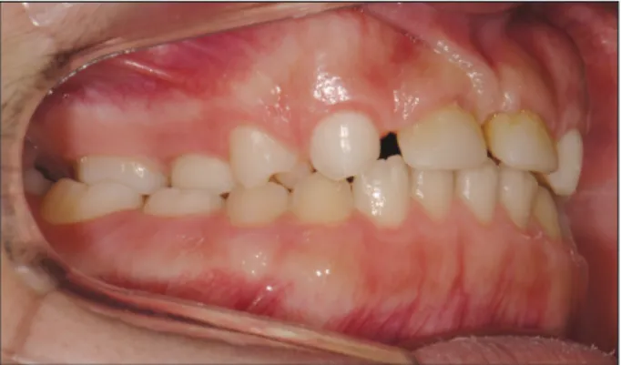 Fig. 10. Intraoral view of maxillary arch.