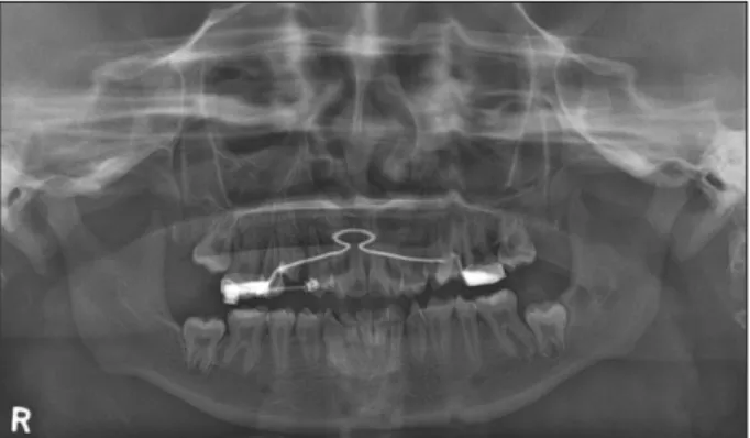 Fig. 3. Space regaining for the impacted canine. Fig. 4. Panoramic view (13Y 6M).