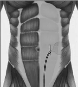 Fig. 1. Access route (arrows) to preperitoneal space for placement of  a reservoir. A, external oblique muscle; B, internal oblique muscle; C,  transversus muscle; D, transversalis fascia.