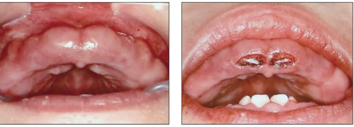 Fig. 1. Intraoral photos before and after 1st electrosurgery. (Age: 1 year 6 months)